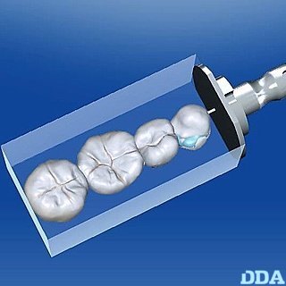 cerec und inlab 5 | 